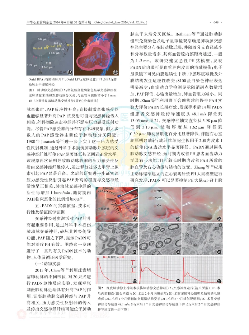 经皮肺动脉去神经术治疗肺动脉高压的中国专家建议