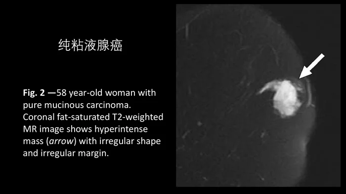 乳腺粘液腺癌MR与病理特点