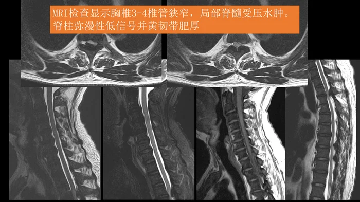 氟骨症的X线CT及MR影像及解读