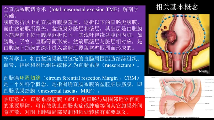 直肠癌：MRI与临床
